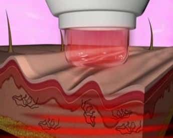 Συσκευή Αναζωογόνησης και Καθαρισμού του Δέρματος Dermawand - Εικόνα 4